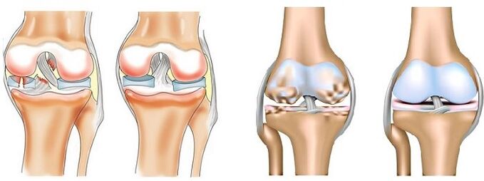 Was ist Arthritis und Arthrose 